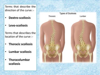 Scoliosis | PPTX