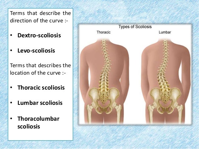 Scoliosis Scoliosis