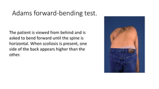 Scoliosis | PPTX