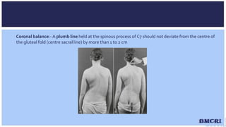 Scoliosis | PPTX