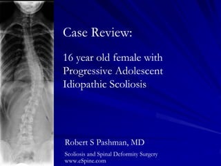 Case Review:
16 year old female with
Progressive Adolescent
Idiopathic Scoliosis




Robert S Pashman, MD
Scoliosis and Spinal Deformity Surgery
www.eSpine.com
 