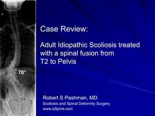 Case Review:

      Adult Idiopathic Scoliosis treated
      with a spinal fusion from
      T2 to Pelvis
70°



      Robert S Pashman, MD
      Scoliosis and Spinal Deformity Surgery
      www.eSpine.com
 