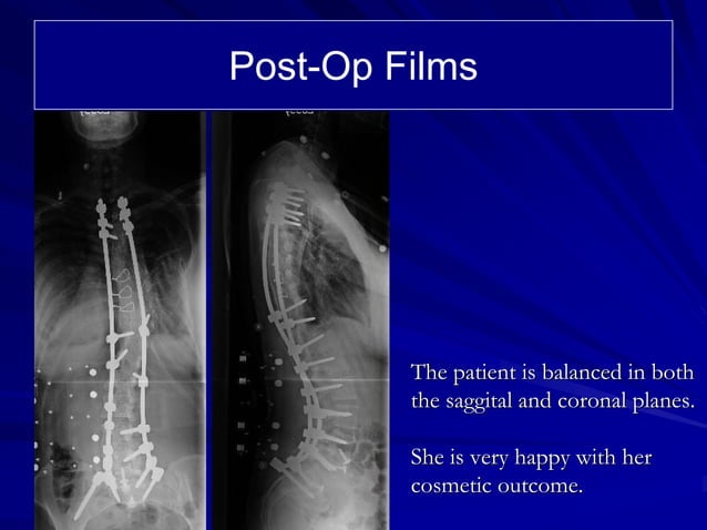 Cd Harrington Rods Case Review #28: Patient with Lumbar Scoliosis status post surgery with ...