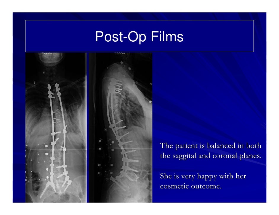 Case Review 28 Patient with Lumbar Scoliosis status post surgery w…