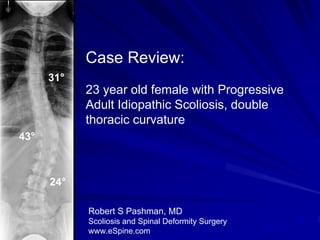 Case Review:
      31°
            23 year old female with Progressive
            Adult Idiopathic Scoliosis, double
            thoracic curvature
43°



      24°

            Robert S Pashman, MD
            Scoliosis and Spinal Deformity Surgery
            www.eSpine.com
 