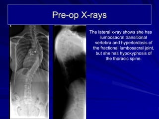 Pre-op X-rays
              The lateral x-ray shows she has
                   lumbosacral transitional
                vertebra and hyperlordosis of
               the fractional lumbosacral joint,
61°              but she has hypokyphosis of
                      the thoracic spine.
 