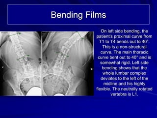 Bending Films
             On left side bending, the
          patient's proximal curve from
            T1 to T4 bends out to 40°.
              This is a non-structural
             curve. The main thoracic
           curve bent out to 40° and is
             somewhat rigid. Left side
              bending shows that the
              whole lumbar complex
             deviates to the left of the
               midline and his highly
          flexible. The neutrally rotated
                   vertebra is L1.
 