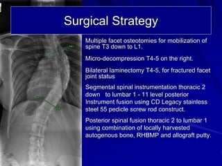 Surgical Strategy
   Multiple facet osteotomies for mobilization of
   spine T3 down to L1.
   Micro-decompression T4-5 on the right.
   Bilateral laminectomy T4-5, for fractured facet
   joint status
   Segmental spinal instrumentation thoracic 2
   down to lumbar 1 - 11 level posterior
   Instrument fusion using CD Legacy stainless
   steel 55 pedicle screw rod construct.
   Posterior spinal fusion thoracic 2 to lumbar 1
   using combination of locally harvested
   autogenous bone, RHBMP and allograft putty.
 