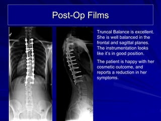 Post-Op Films
          Truncal Balance is excellent.
          She is well balanced in the
          frontal and sagittal planes.
          The instrumentation looks
          like it’s in good position.
          The patient is happy with her
          cosmetic outcome, and
          reports a reduction in her
          symptoms.
 