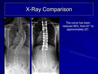 X-Ray Comparison

                     The curve has been
                  reduced 36%, from 61° to
                     approximately 22°.
61°       22°
 