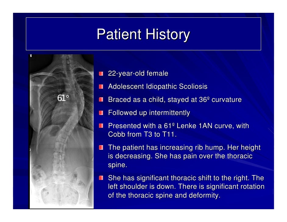 Case Review 4 Adolescent Idiopathic Scoliosis with 61 degree curvat…