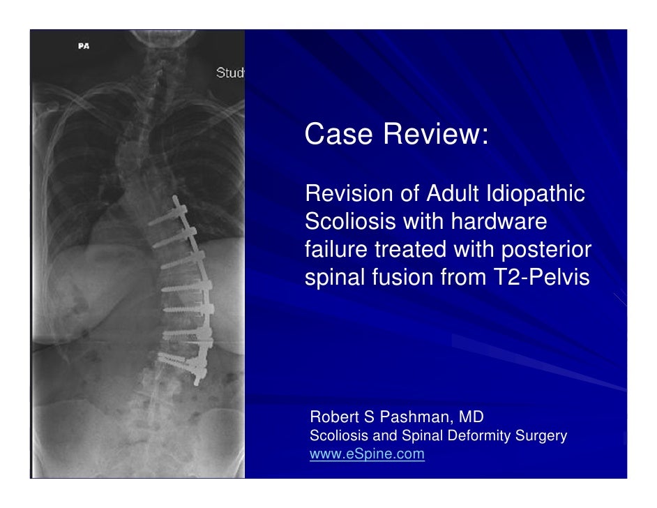 Case Review 23 Scoliosis Revision Surgery for Hardware Failure