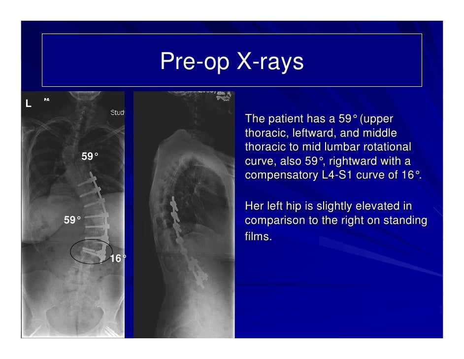 Case Review 23 Scoliosis Revision Surgery for Hardware Failure