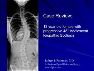 Case Review:

      13 year old female with
      progressive 48° Adolescent
48°   Idiopathic Scoliosis




      Robert S Pashman, MD
      Scoliosis and Spinal Deformity Surgery
      www.eSpine.com
 