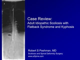 Case Review:
Adult Idiopathic Scoliosis with
Flatback Syndrome and Kyphosis




Robert S Pashman, MD
Scoliosis and Spinal Deformity Surgery
www.eSpine.com
 