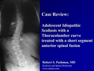 Case Review:
37°
            Adolescent Idiopathic
            Scoliosis with a
            Thoracolumber curve
      45°   treated with a short segment
            anterior spinal fusion


            Robert S. Pashman, MD
            Scoliosis and Spinal Deformity
            www.eSpine.com
 