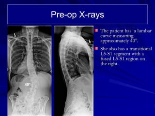 Pre-op X-rays
                  The patient has a lumbar
                  curve measuring
                  approximately 40°.
                  She also has a transitional
                  L5-S1 segment with a
                  fused L5-S1 region on
                  the right.



40°
 