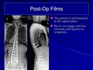 Post-Op Films
         The patient is well balanced
         in the sagittal plane.
         She is very happy with her
         outcome, and reports no
         symptoms.
 