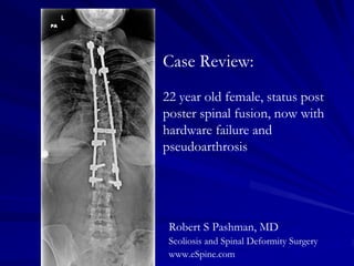 Case Review:
22 year old female, status post
poster spinal fusion, now with
hardware failure and
pseudoarthrosis




 Robert S Pashman, MD
 Scoliosis and Spinal Deformity Surgery
 www.eSpine.com
 