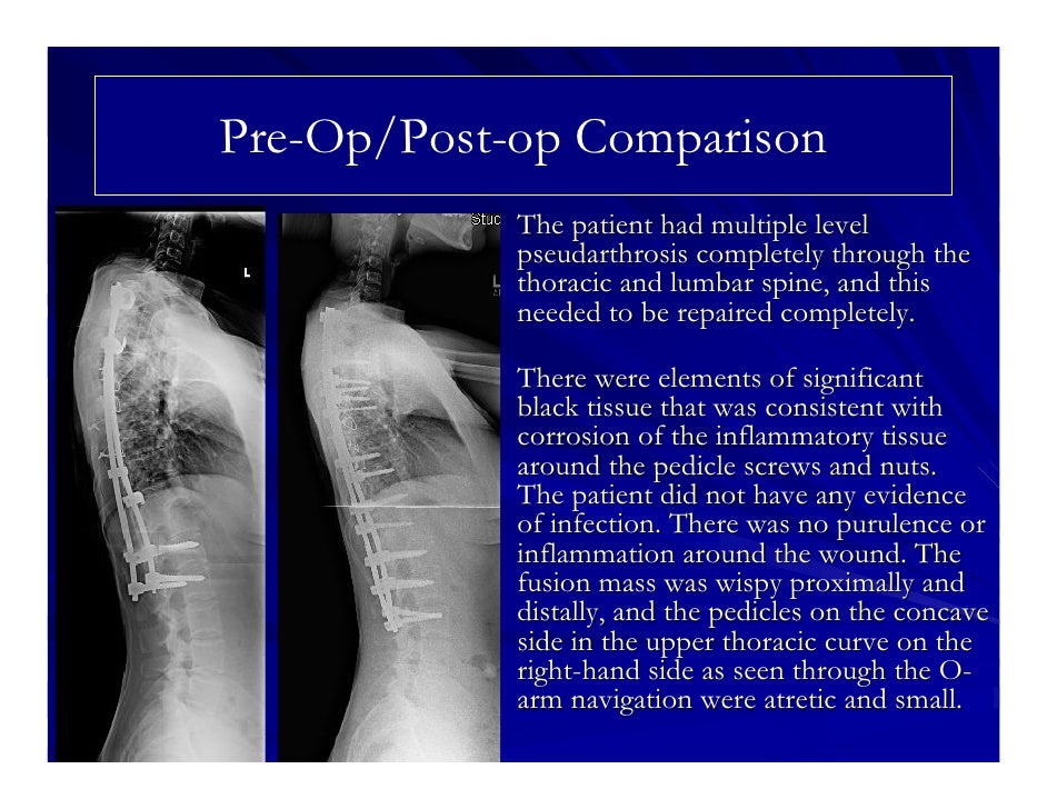 How to sleep with retrolisthesis image