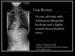 Case Review:
             16 year old male with
             Adolescent Idiopathic
58°
             Scoliosis and a highly
             rotated thoracolumbar
      69°    curve.


             Robert S Pashman, MD
             Scoliosis and Spinal Deformity Surgery
             www.eSpine.com
 