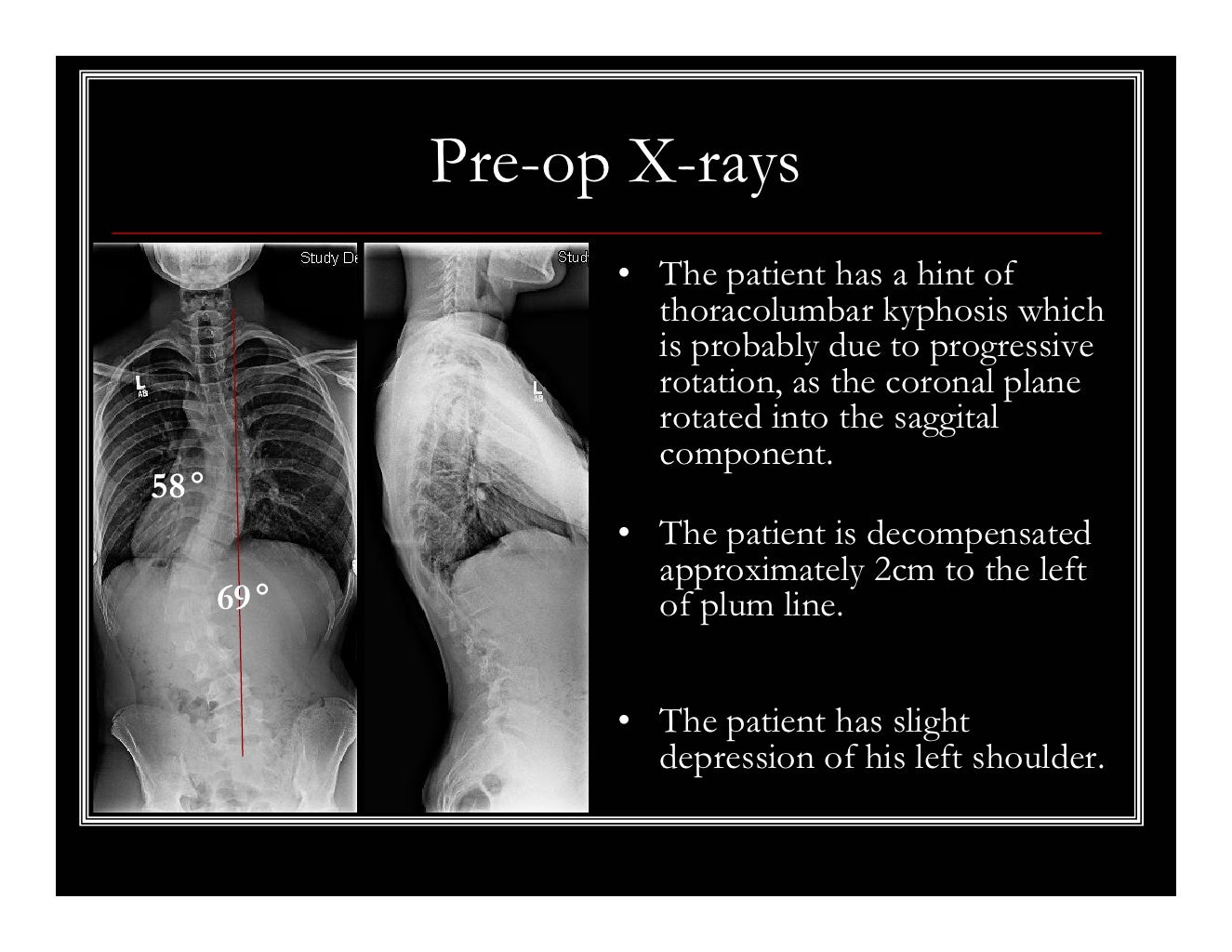 Case Review 16 16 year old male with Highly Rotated Adolescent Idio…