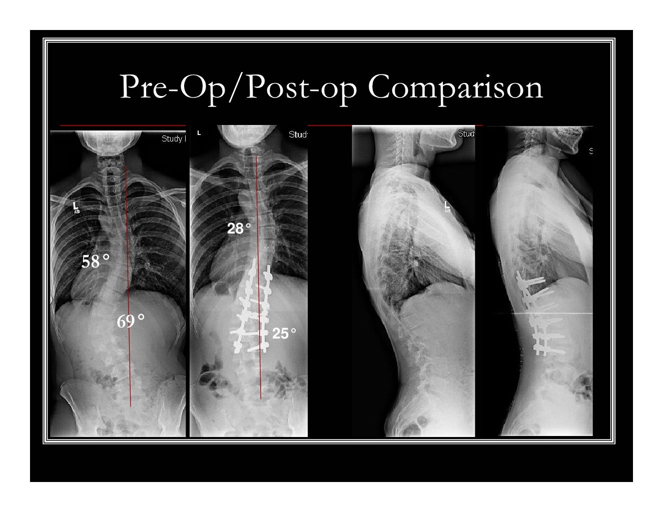 Case Review 16 16 year old male with Highly Rotated Adolescent Idio…