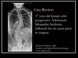 Case Review:
            17 year old female with
            progressive Adolescent
57°
            Idiopathic Scoliosis,
            followed for six years prior
58°   52°   to surgery.


             Robert S Pashman, MD
             Scoliosis and Spinal Deformity Surgery
             www.eSpine.com
 