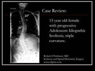 Case Review:
      24°
                 15 year old female
41°
                 with progressive
                 Adolescent Idiopathic
                 Scoliosis, triple
      51°        curvature.


            Robert S Pashman, MD
            Scoliosis and Spinal Deformity Surgery
            www.eSpine.com
 