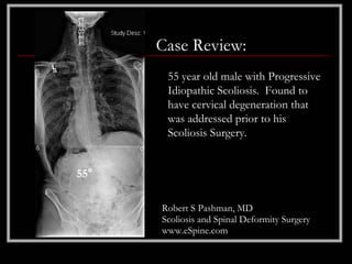 Case Review:
       55 year old male with Progressive
       Idiopathic Scoliosis. Found to
       have cervical degeneration that
       was addressed prior to his
       Scoliosis Surgery.


55°

      Robert S Pashman, MD
      Scoliosis and Spinal Deformity Surgery
      www.eSpine.com
 