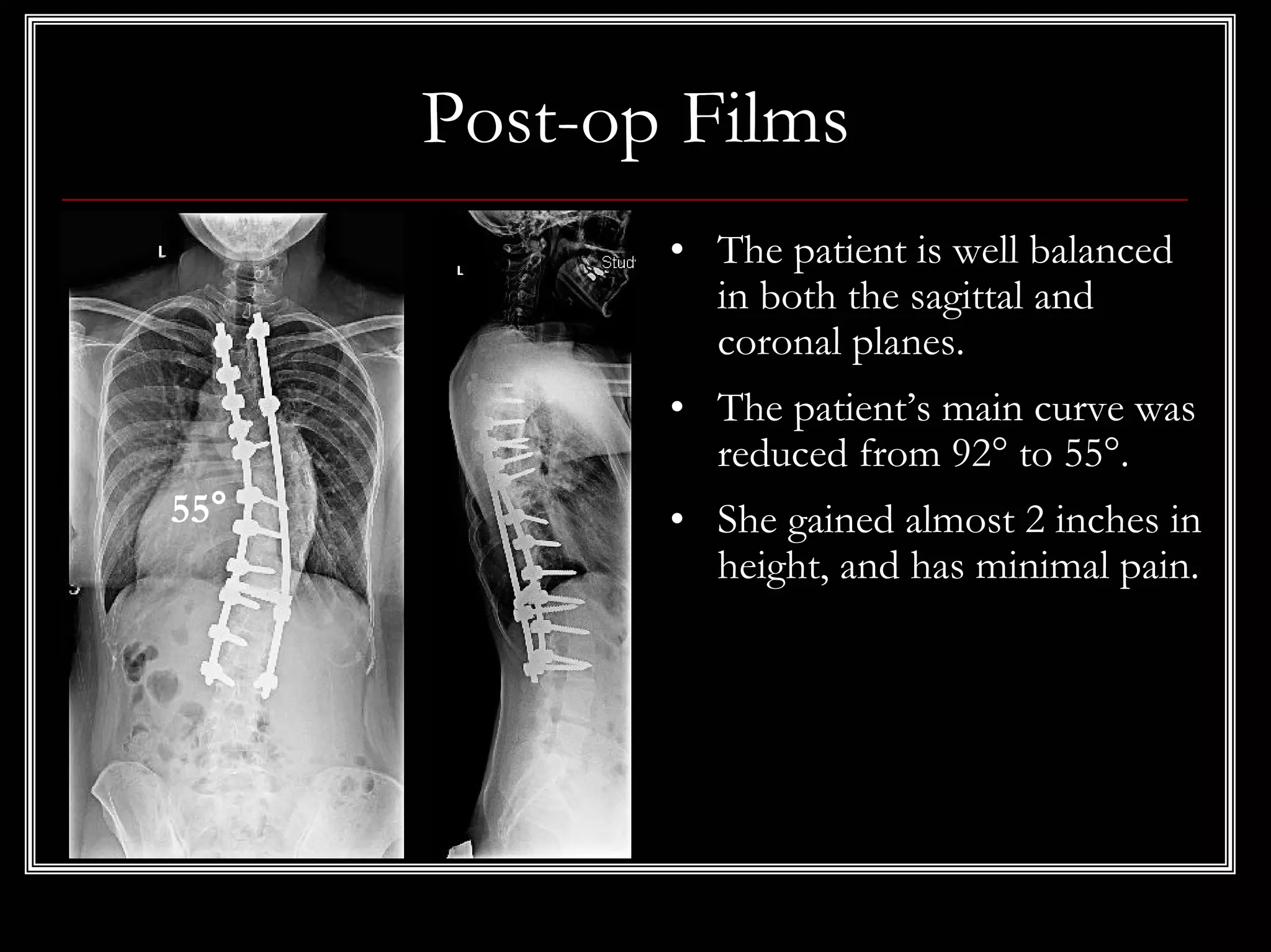 Case Review #41: 35 year old female with a 92 degree Scoliosis | PDF