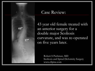 Case Review:

            43 year old female treated with
60°         an anterior surgery for a
            double major Scoliosis
            curvature, and was re-operated
      57°
            on five years later.


               Robert S Pashman, MD
               Scoliosis and Spinal Deformity Surgery
               www.eSpine.com
 