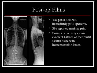 Post-op Films
      • The patient did well
        immediately post-operative.
      • She reported minimal pain.
      • Postoperative x-rays show
        excellent balance of the frontal
        sagittal plane with
        instrumentation intact.
 