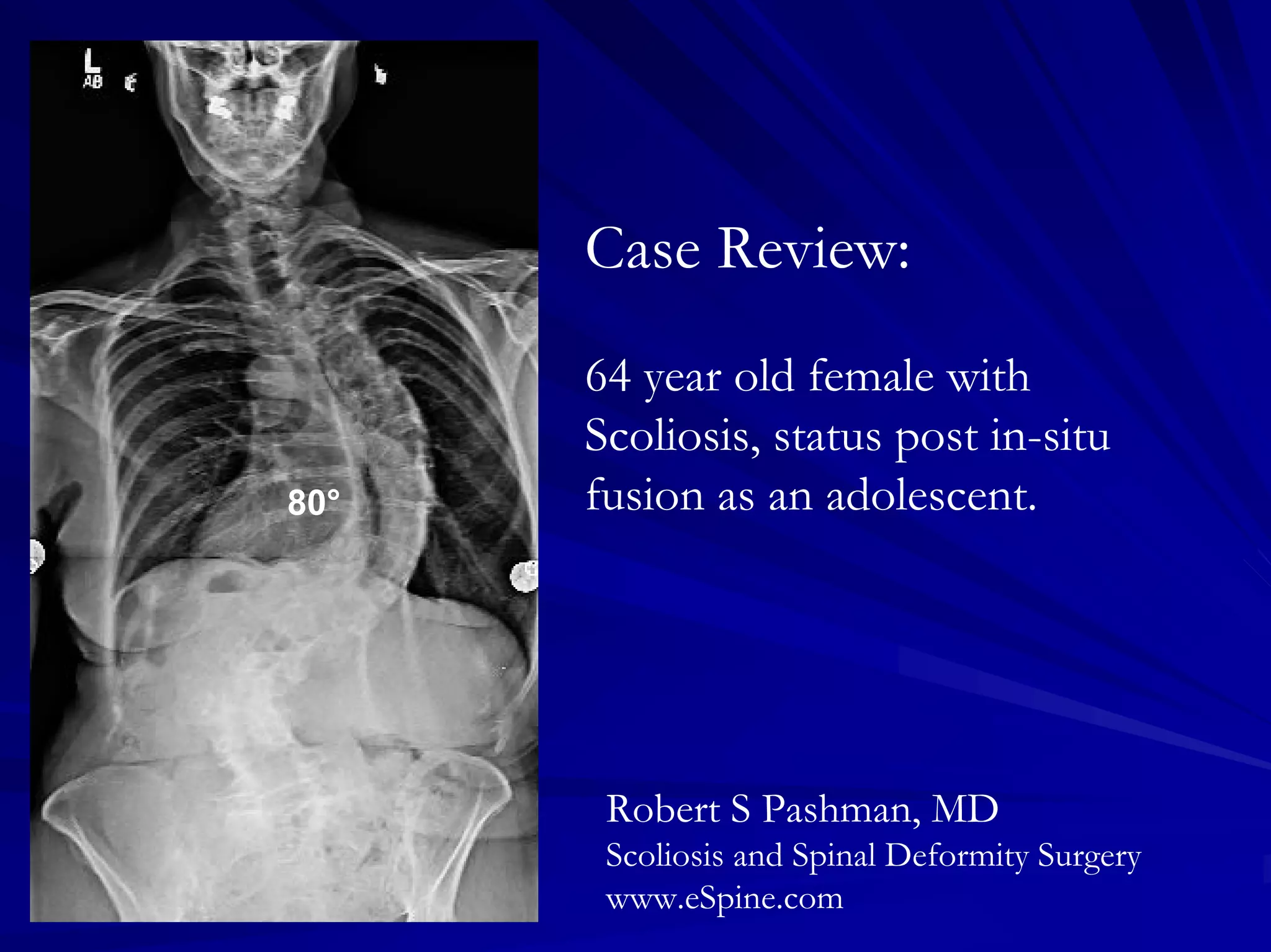 Case Review #37: 64 year old female with Scoliosis | PDF | Death ...