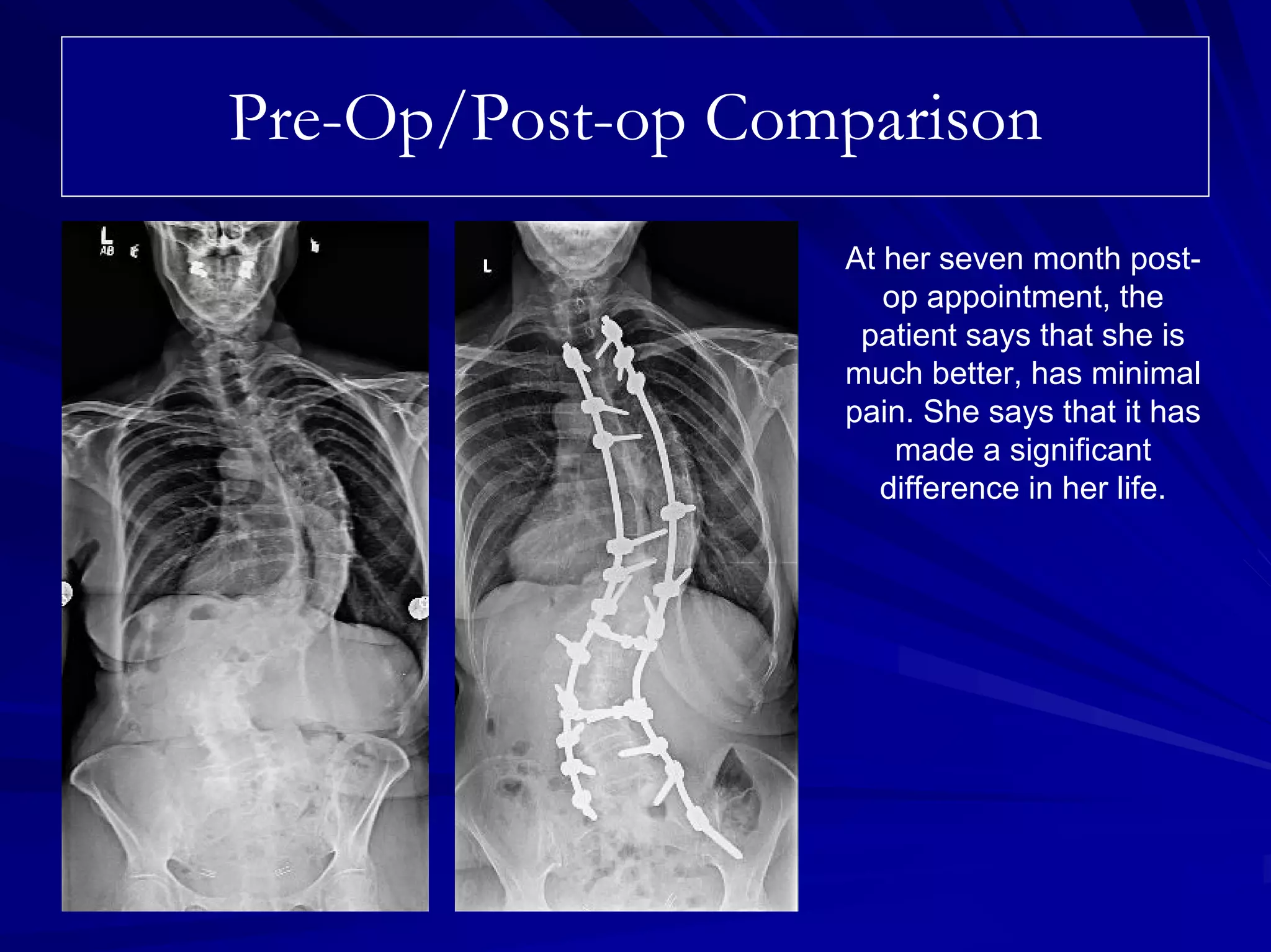 Case Review #37: 64 year old female with Scoliosis | PDF | Death ...