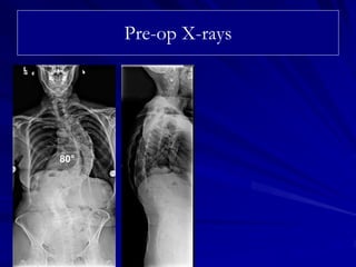 Case Review #37: 64 year old female with Scoliosis | PDF
