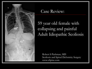 Case Review:

            59 year old female with
60°         collapsing and painful
            Adult Idiopathic Scoliosis
      60°



              Robert S Pashman, MD
              Scoliosis and Spinal Deformity Surgery
              www.eSpine.com
 