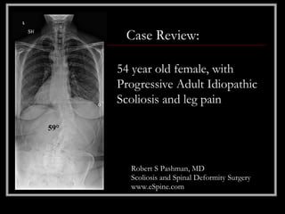 Case Review:

      54 year old female, with
      Progressive Adult Idiopathic
      Scoliosis and leg pain

59°




        Robert S Pashman, MD
        Scoliosis and Spinal Deformity Surgery
        www.eSpine.com
 