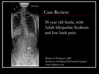 Case Review:
      58 year old famle, with
      Adult Idiopathic Scoliosis
      and low back pain.


38°

      Robert S Pashman, MD
      Scoliosis and Spinal Deformity Surgery
      www.eSpine.com
 