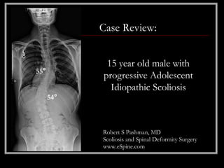 Case Review:


             15 year old male with
55°
            progressive Adolescent
              Idiopathic Scoliosis
      54°



            Robert S Pashman, MD
            Scoliosis and Spinal Deformity Surgery
            www.eSpine.com
 
