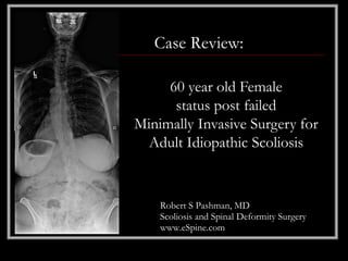 Case Review:

     60 year old Female
      status post failed
Minimally Invasive Surgery for
  Adult Idiopathic Scoliosis


    Robert S Pashman, MD
    Scoliosis and Spinal Deformity Surgery
    www.eSpine.com
 