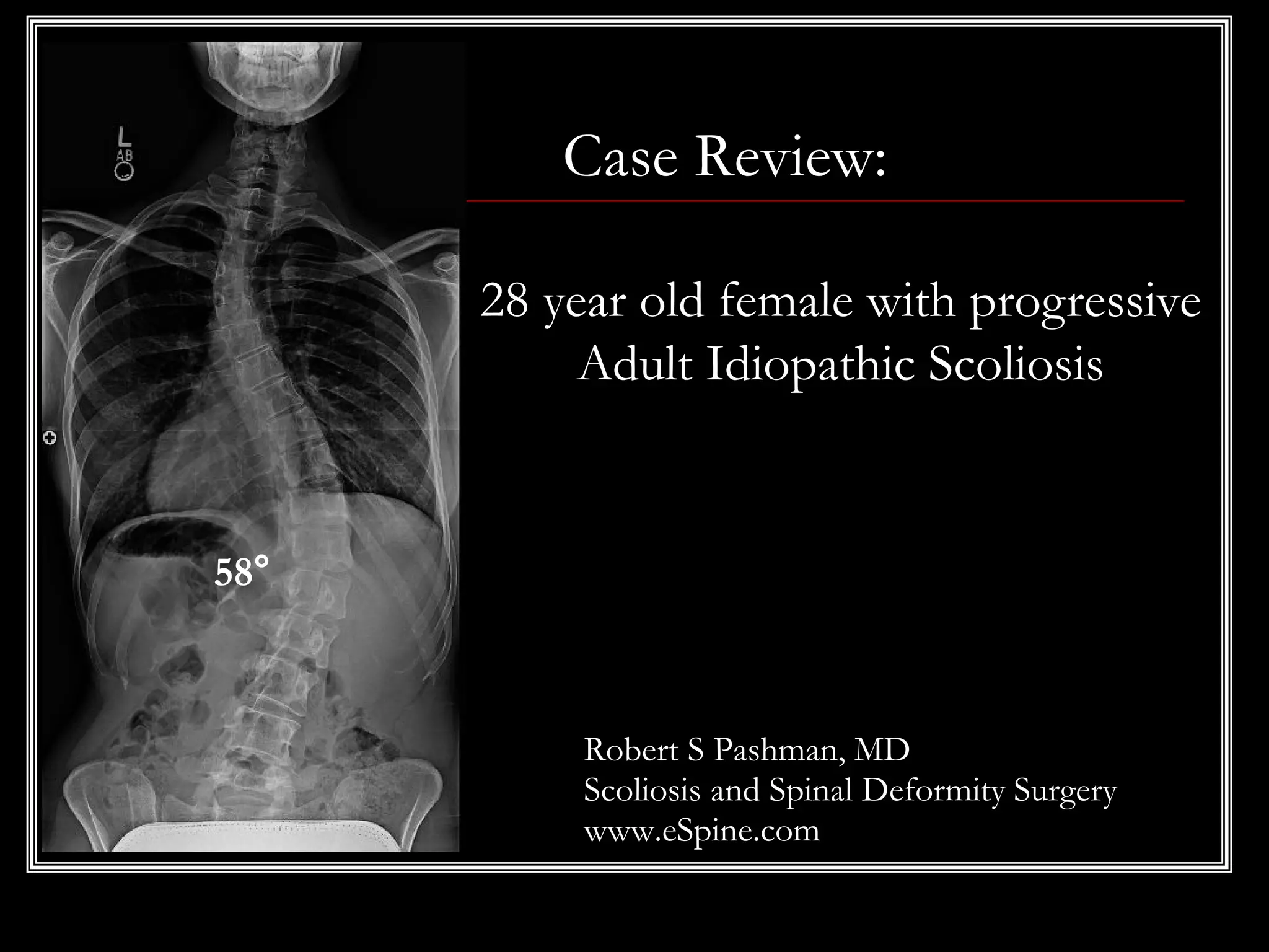 Case Review:
28 year old female with progressive
Adult Idiopathic Scoliosis
58°
Robert S Pashman, MD
Scoliosis and Spinal Deformity Surgery
www.eSpine.com