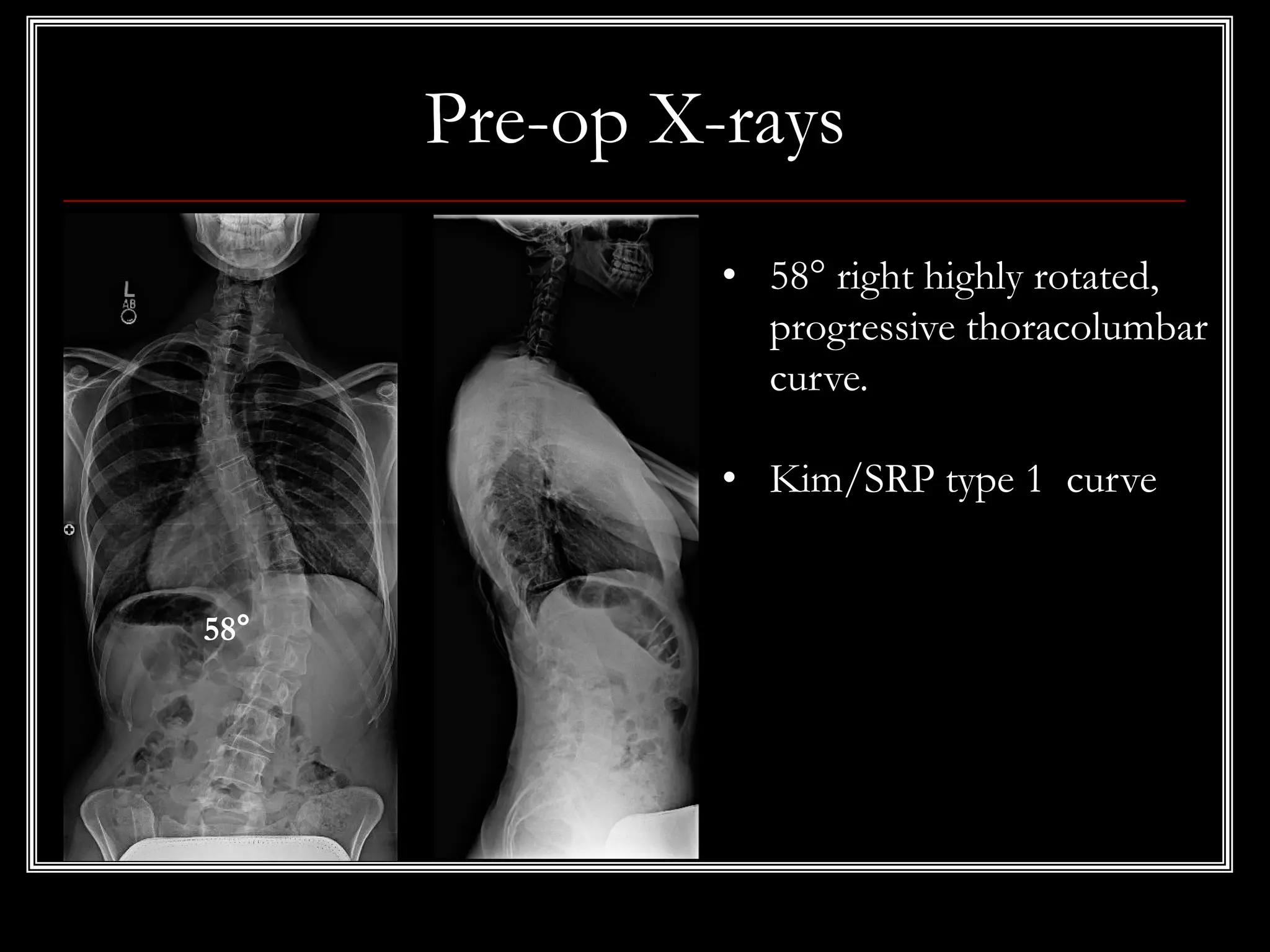 Pre-op X-rays
• 58° right highly rotated,
progressive thoracolumbar
curve.
• Kim/SRP type 1 curve
58°