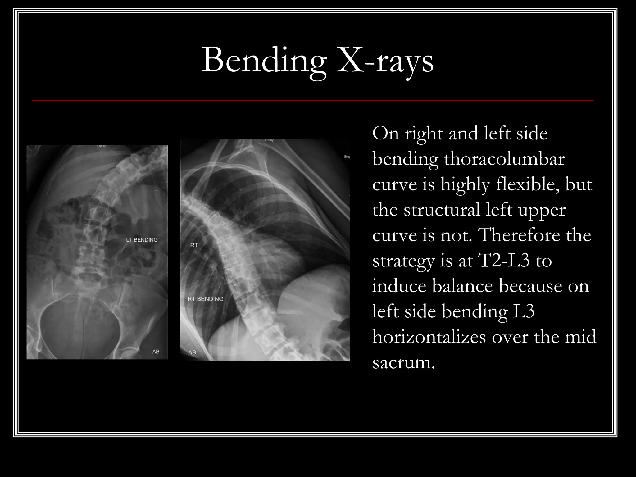 Bending X-rays
On right and left side
bending thoracolumbar
curve is highly flexible, but
the structural left upper
curve is not. Therefore the
strategy is at T2-L3 to
induce balance because on
left side bending L3
horizontalizes over the mid
sacrum.