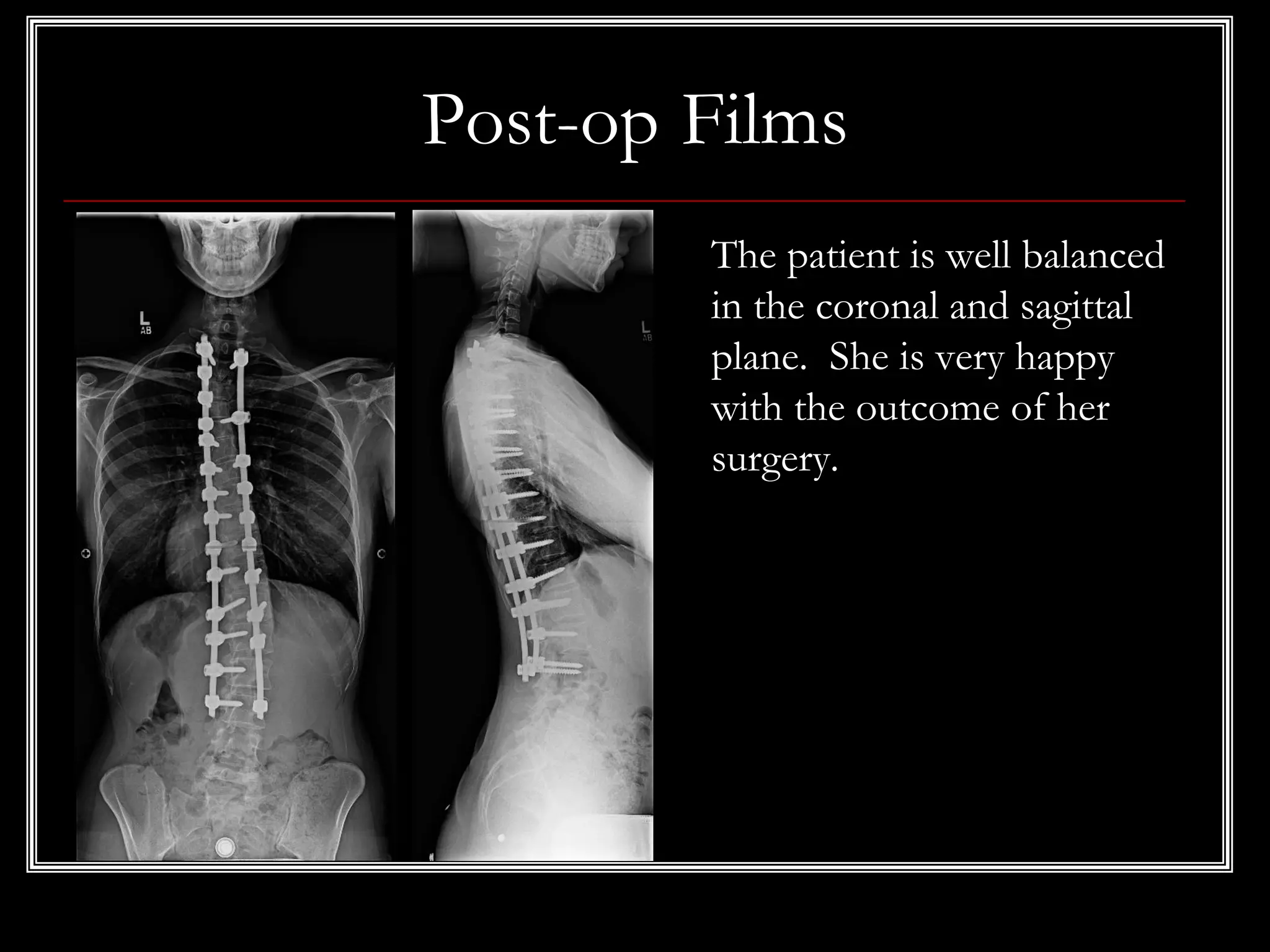 Post-op Films
The patient is well balanced
in the coronal and sagittal
plane. She is very happy
with the outcome of her
surgery.