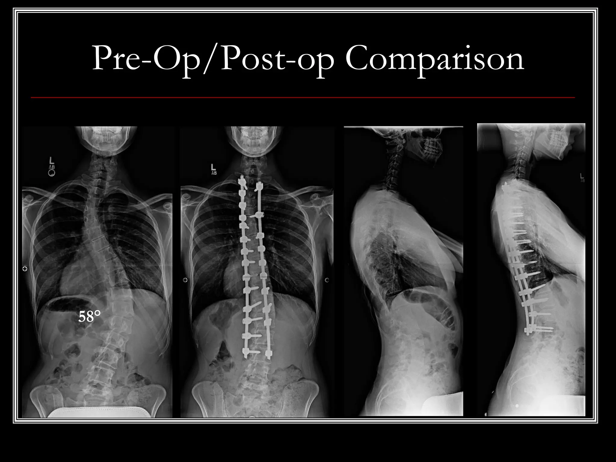 Pre-Op/Post-op Comparison
58°