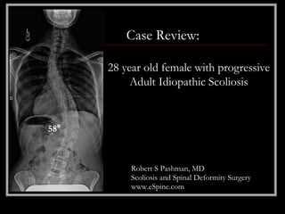 Case Review:

      28 year old female with progressive
           Adult Idiopathic Scoliosis


58°



           Robert S Pashman, MD
           Scoliosis and Spinal Deformity Surgery
           www.eSpine.com
 