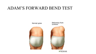 Adams Test scoliosis and kyphosis diagnosis and treatment | PPTX