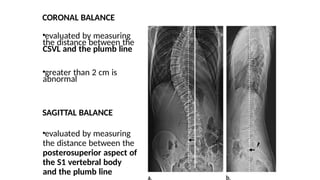 scoliosis and kyphosis diagnosis and treatment | PPTX