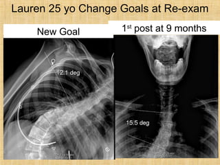 1st
Nasium View 1st
Goal1st
post at 9 monthsNew Goal
Lauren 25 yo Change Goals at Re-exam
 